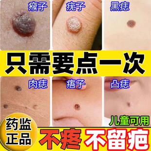点痣膏无痕正品旗舰店祛痣药水不留疤点痣点斑去痦子专用修护液pk