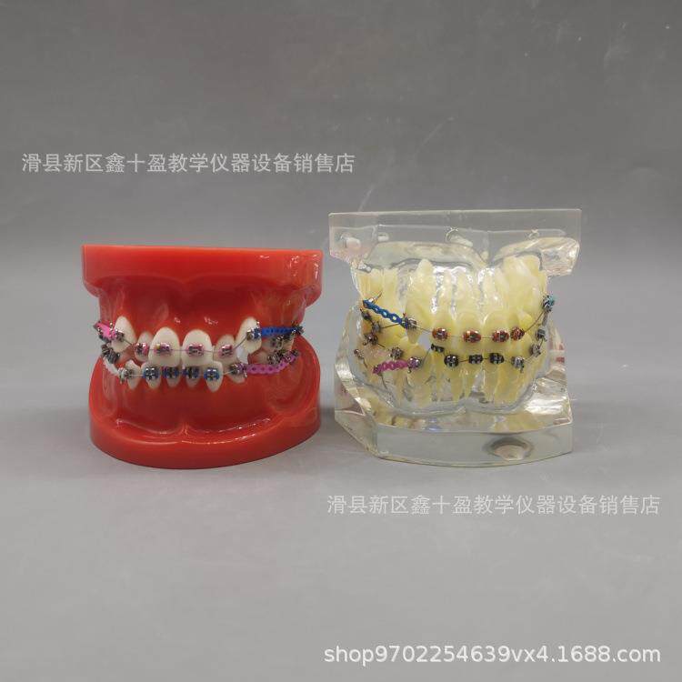牙齿正畸模型 缺失牙错颌牙列不齐矫正 金属托槽带支抗牵引皮拉链