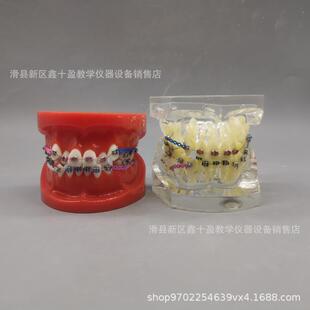 牙齿正畸模型缺失牙错颌牙列不齐矫正金属托槽带支抗牵引皮拉链
