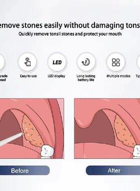 Electric Tonsil Stone Remover Tonsil Stone Removal Kit