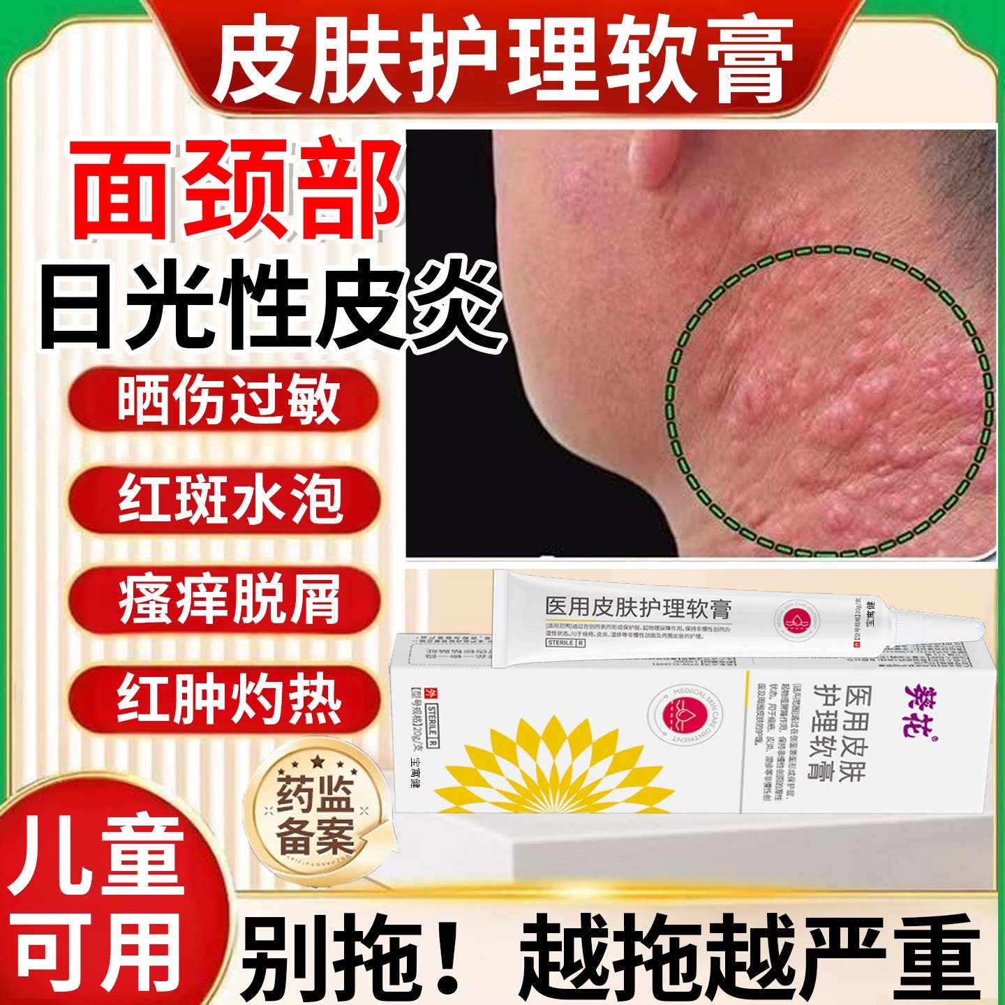日光性皮炎皮肤瘙痒敷料外用皮炎湿痒止痒药膏皮癣紫外线过敏晒斑