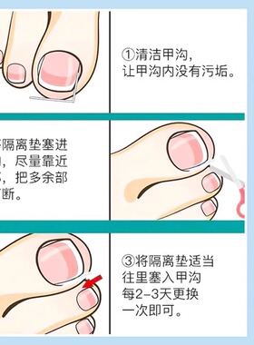 矫正器指甲专用趾甲纠正美甲工具