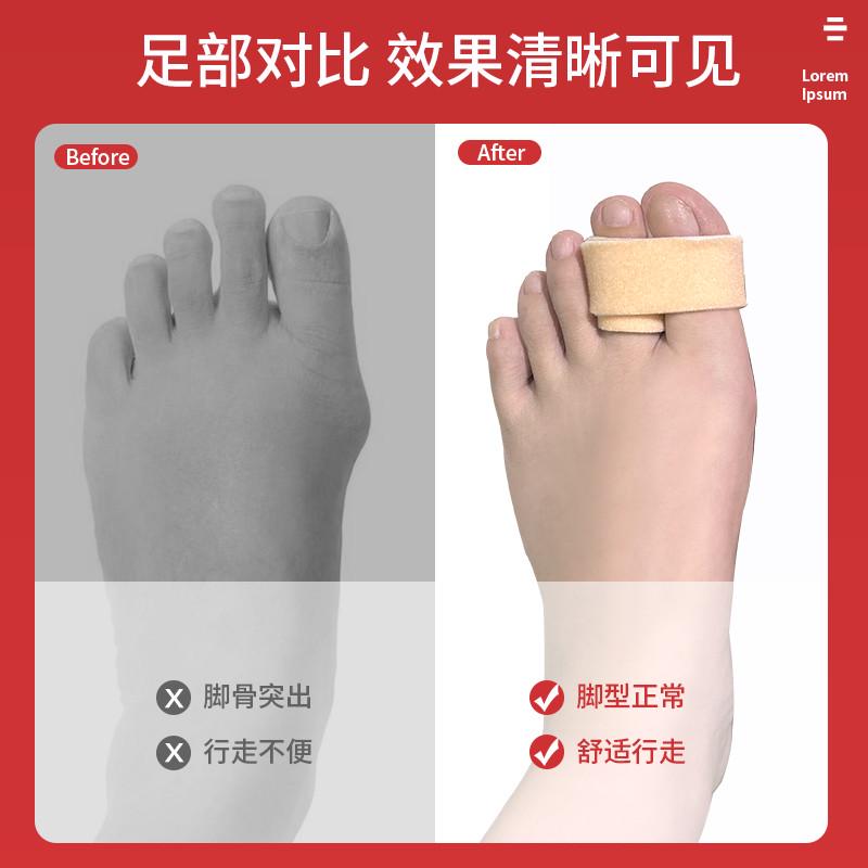 婴幼儿童小孩宝宝脚趾矫正器分趾器纠正大母指重叠外翻弯曲大拇指