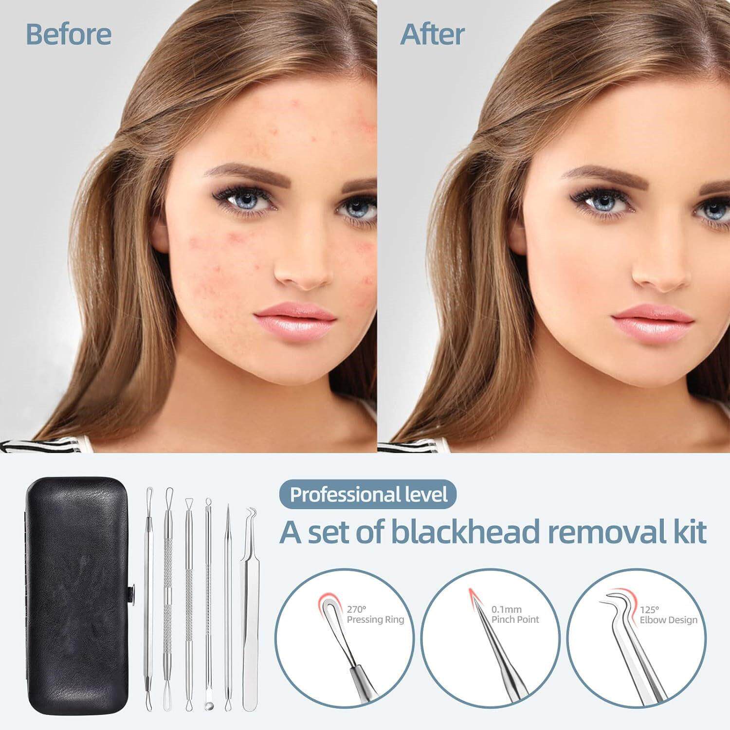Blackhead Remover Tool Blemish Whitehead Popping Zit图片