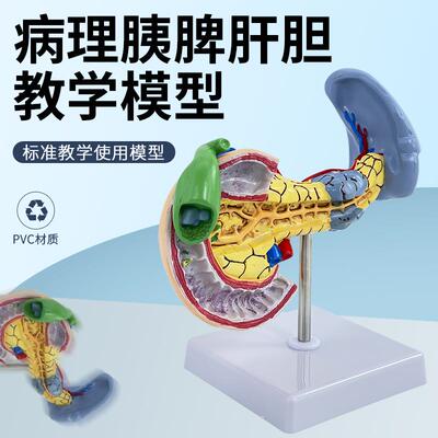 病态脾脏模型 病变胰、脾、十二指肠 胰腺解剖 脾脏模型胰腺病理