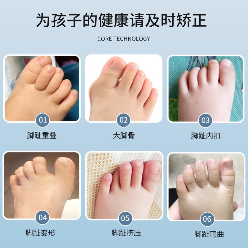 儿童脚趾外翻矫正器成人拇指外翻纠正神器宝宝专用重叠分趾固定器