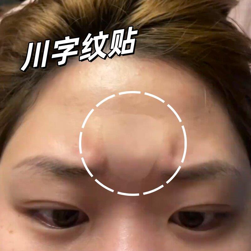 川字纹去除神器睡觉专用额头贴抬头纹法令纹提拉改善眼角褶皱贴纸