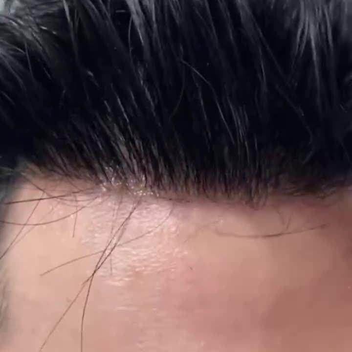 瑞士网男士真人发前额无痕假发片全递针头顶顶发