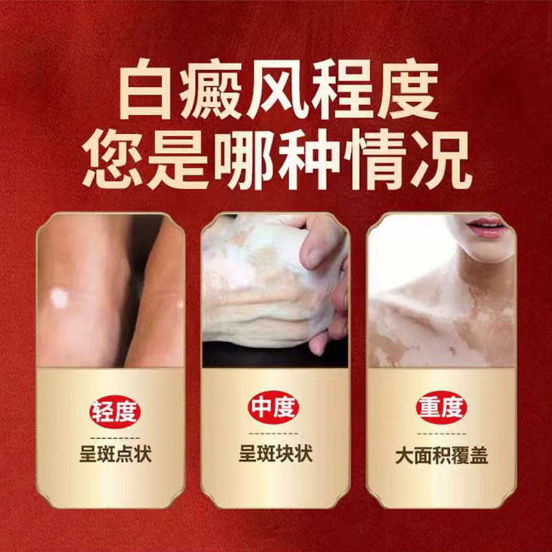 【根冶】白癜风外用黑色素生长专用快速白斑药膏补骨脂酊汗斑消净