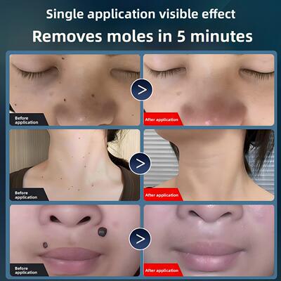 百世小白斑痣笔激光去斑痣祛斑美容院专用祛斑仪黑痣祛斑器