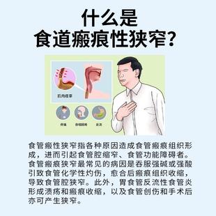 食道瘢痕性狭窄食道癌术后胃食道反流烧心溃烂黏膜修复搭膏药贴QK