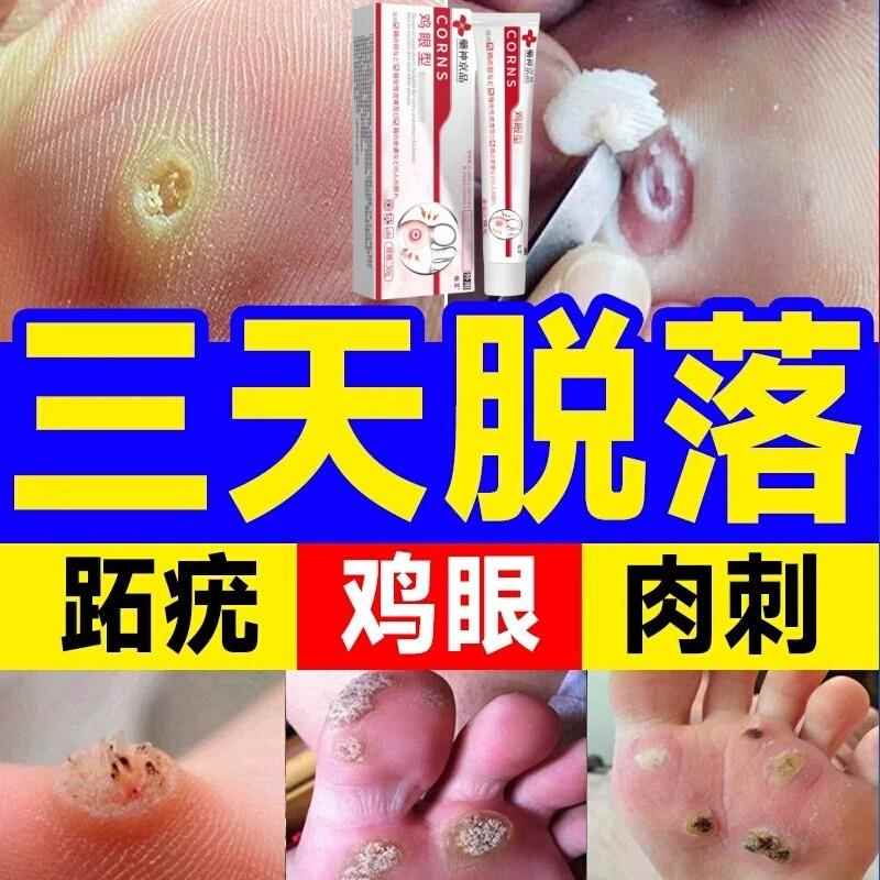 日本正品专鸡眼药膏去除脚底扁平疣瘊尤瘊小肉粒鸡眼贴软化角质用