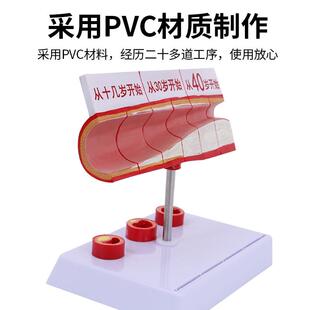 堵塞心血管型血栓脂血模856液浓度肪病理粥样硬化人体血管解剖模