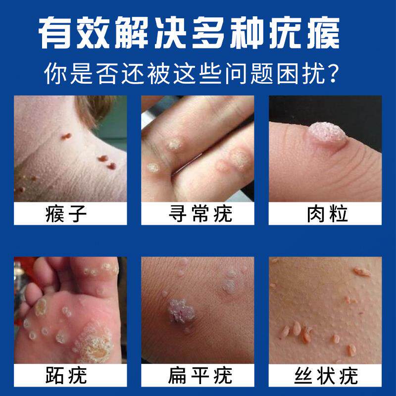 去除尤疣瘊猴子除扁平疣神器脖子上长小肉粒疙瘩一抹无忧灵药膏01