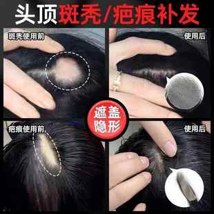 疤痕补发贴伤疤头顶斑秃假发贴全真发定制生物头皮粘贴男女补发片
