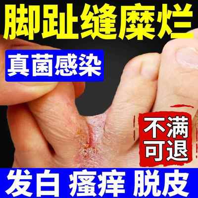 糜烂型性脚气脚丫子脱皮脚趾缝痒脚部去真菌感染可搭配烂脚药膏JW