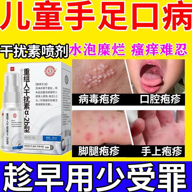 手足口病搭药膏重组人工干扰素a2b喷雾剂儿童疱疹性咽峡炎口腔α6