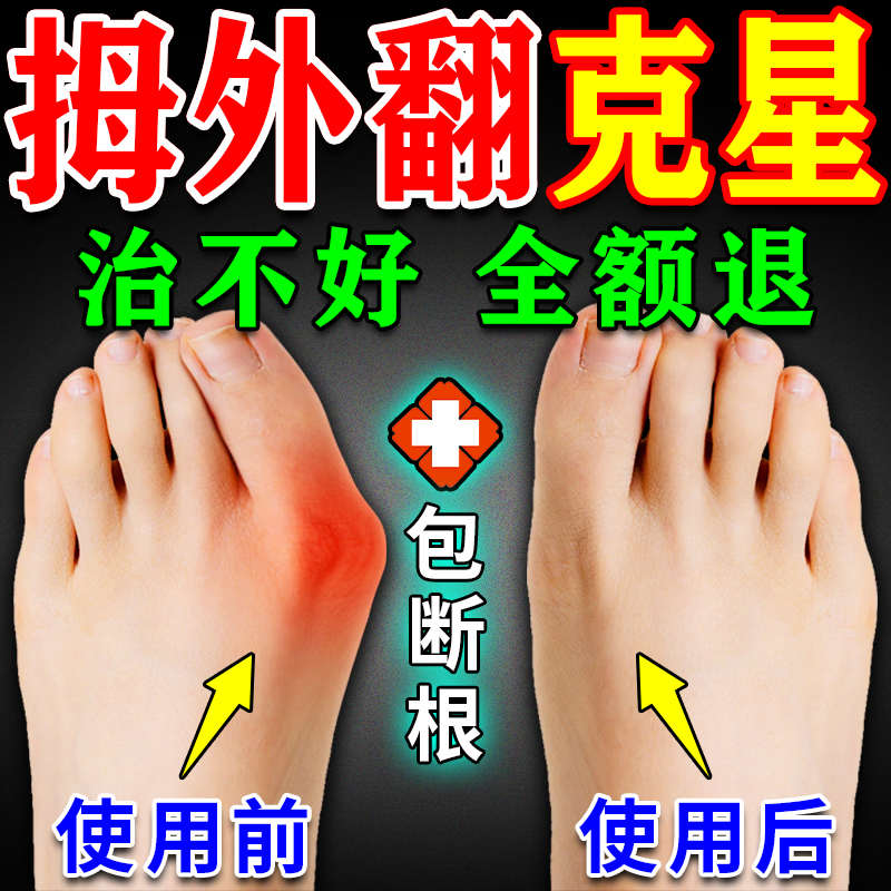 同仁堂拇指外翻药膏贴大母脚趾拇外翻矫正器女士大脚骨专用药神器