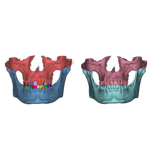 Mimics 3D Slicer口腔泌尿骨科医学三维重建CT图像处理分割帮代做