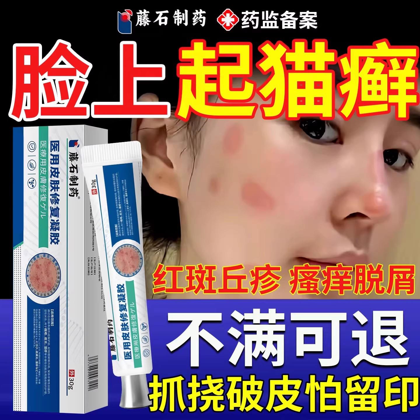猫癣人用药房同售膏脸上长癣人患猫癣铜钱癣红斑染瘙痒感真菌SK医