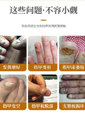 正林甲康灰甲发护理液坏甲空甲增厚灵黄SGL草泰本抑菌液