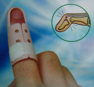 ober护指H0-20,手指肌腱断裂,锤状指,末节骨折扭伤等