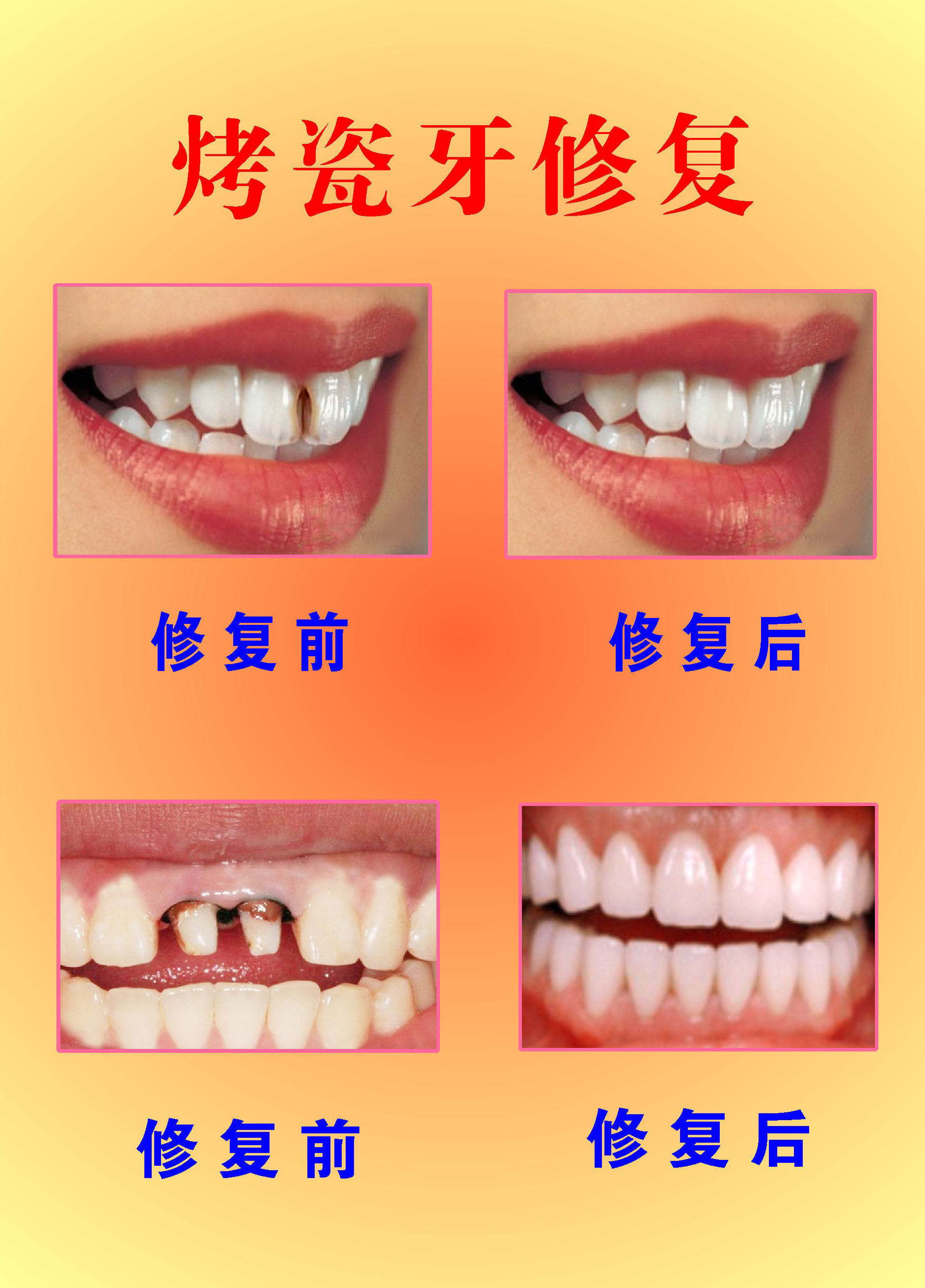 435海报印制海报展板素材12烤瓷牙修复