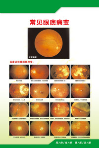 744海报印制展板写真喷绘贴纸1130医院常见眼底病变挂图