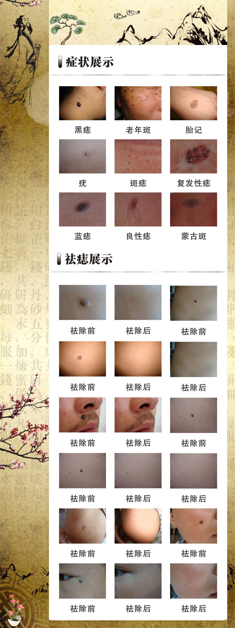 740美容院祛痣前后对比图片贴纸定制868海报印制展板写真喷绘贴纸