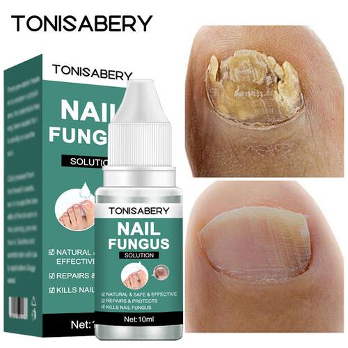 Nail Fungal Treatment Feet Care Essence  Anti Infection Paro