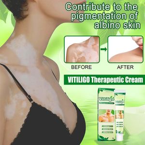 推荐White Spot Remover Cream Herbal Antibacterial Vitiligo T