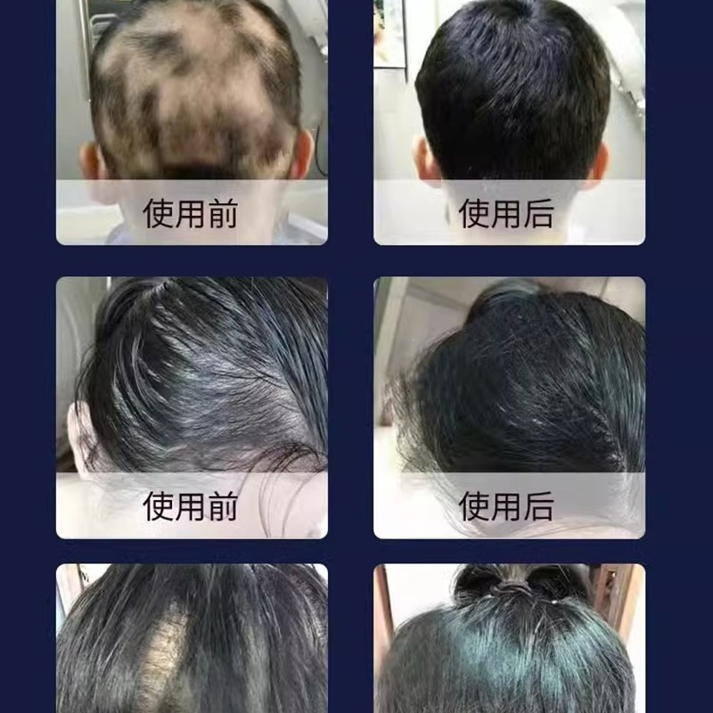 推荐生髪增发密发鬼剃发药脱发严重男女专用脂溢性脱发治疗斑秃的