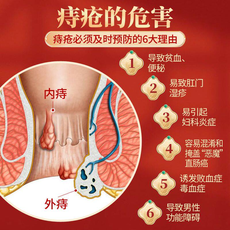 推荐神迹痔疮保健栓男女性内痔外痔混合痔肛裂瘙痒便血根肿肉球痔