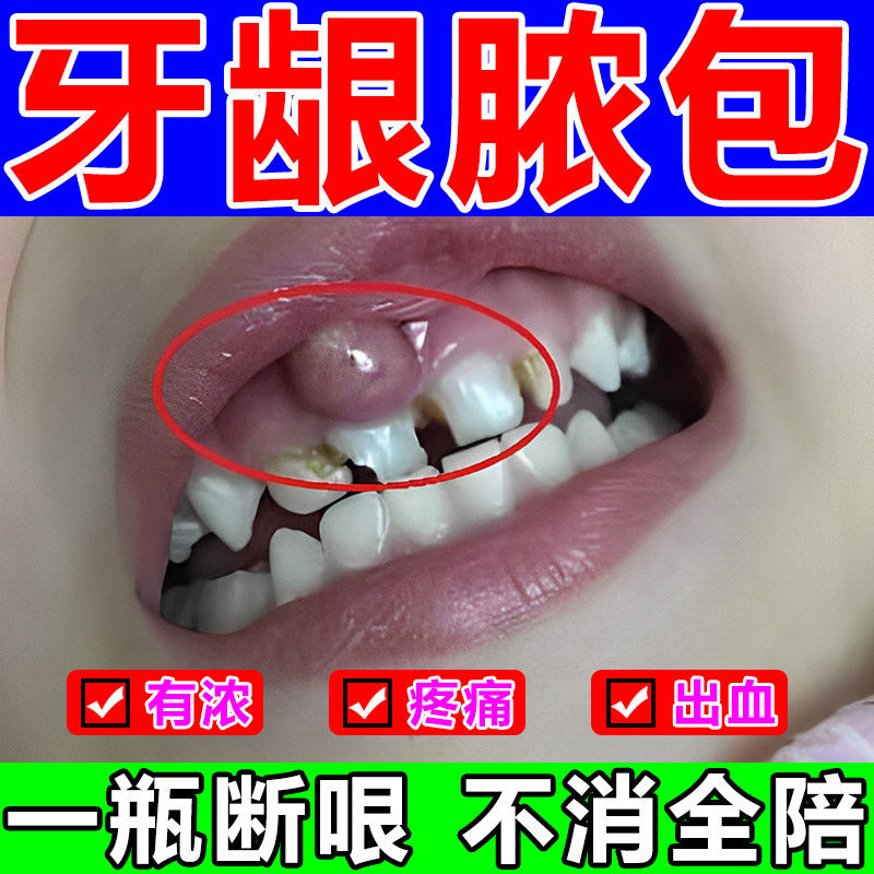 牙根发炎牙龈脓包【200%消除】喷剂牙根肿痛发炎出血专用药