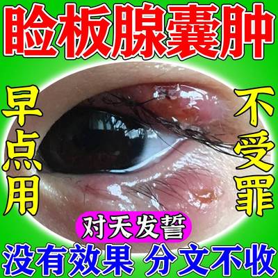 霰粒肿热敷眼膜治疗眼皮红肿瘙痒流E脓疼痛眼睑板腺疏通麦粒肿神