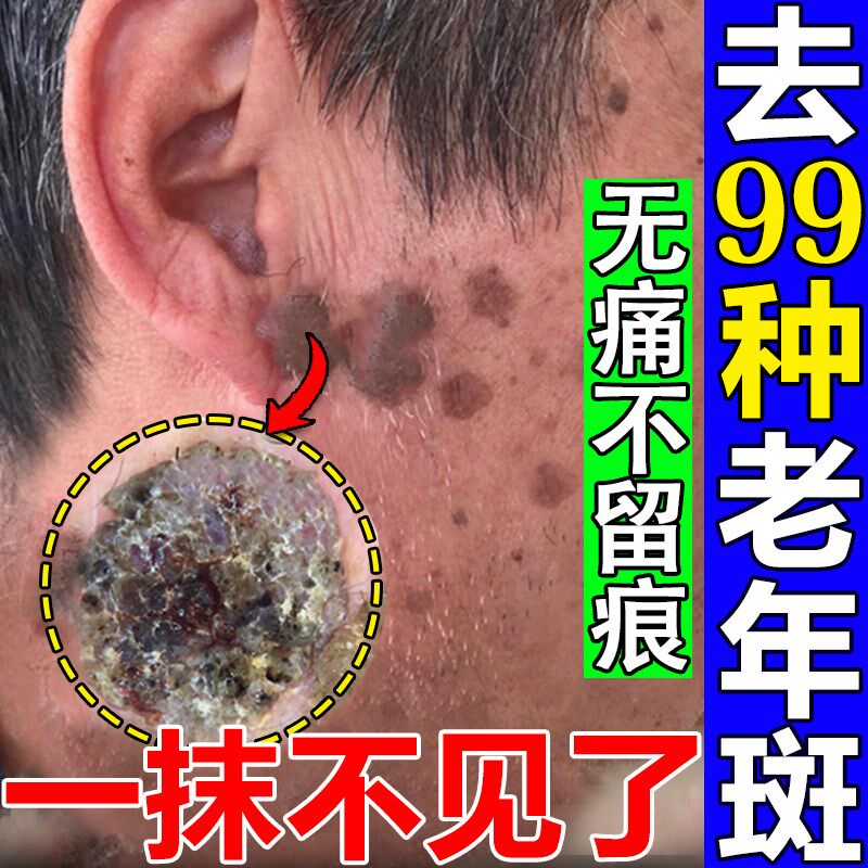 去老年斑的药膏强力去除手部脸部黄褐斑雀斑黑色素一抹净专用正品
