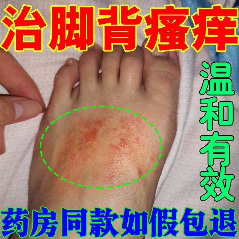 速发夏天天热皮肤痒脚背脚杆发痒专用烂脚丫脚上起红疙瘩红斑抑菌