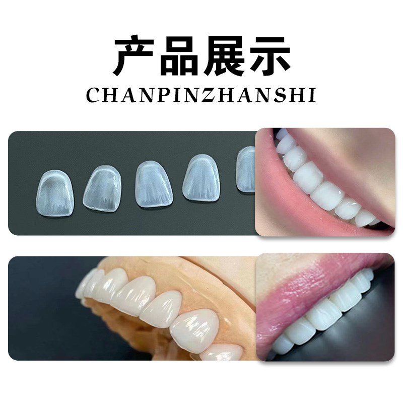 牙齿贴面全瓷牙贴片义获嘉全瓷贴面全瓷牙缝牙齿贴面陶瓷遮色美牙