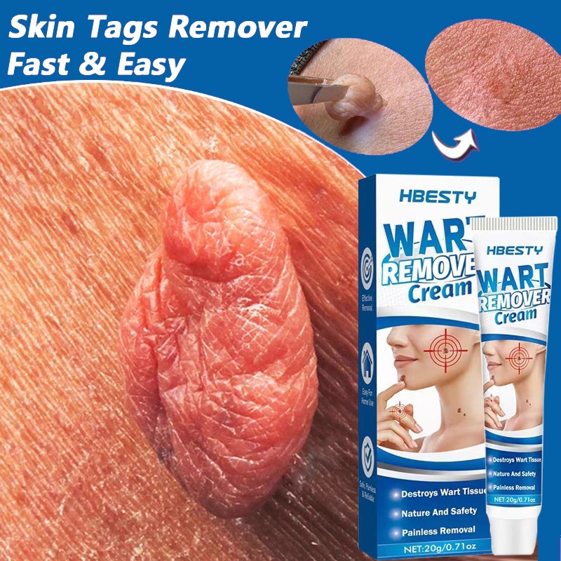 网红Skin Tag Remover Cream Painless Mole Skin Dark Spot Wart