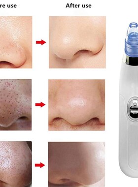 Acne Pimple Clean-Skin-Tool Removal-Face Blackhead-Remover D