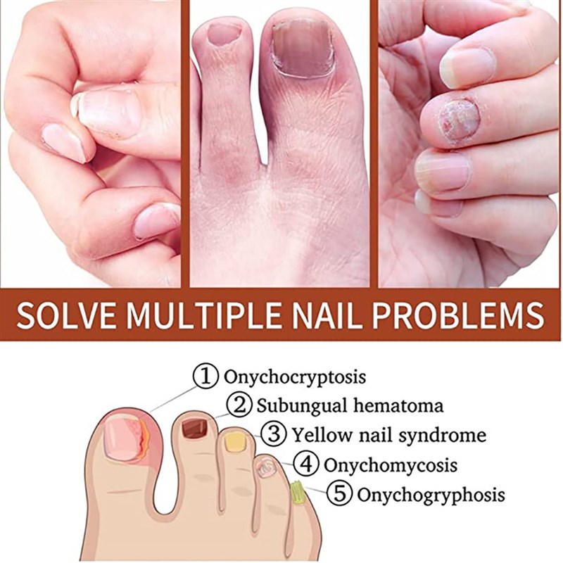 速发iBeaLee Repair Grey Nail Fungus Treatments Essence Foot