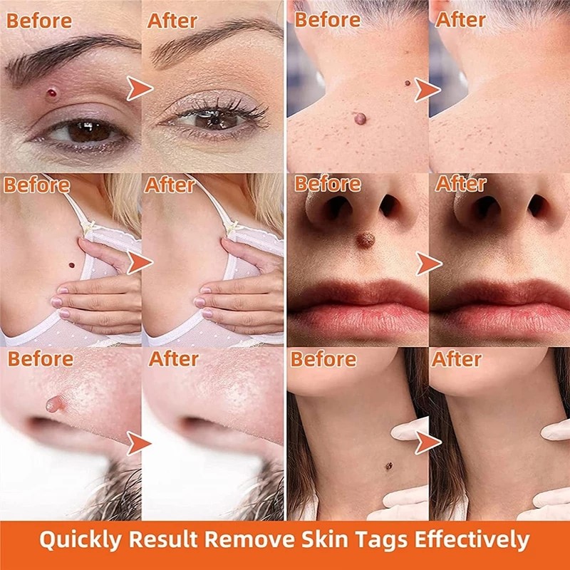 网红Skin Tag Remover Cream Painless Mole Skin Dark Spot Wart