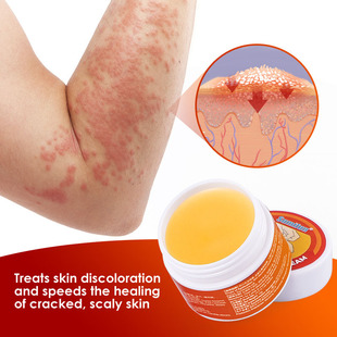 Dermatitis Cream Psoriasis 新品 Eczematoid Herbbal Treatment