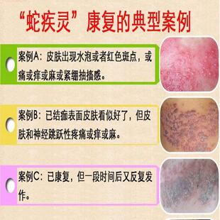 后后症外用痒蛇盘疮膏蛇胆疮缠腰龙遗遗症刺药w