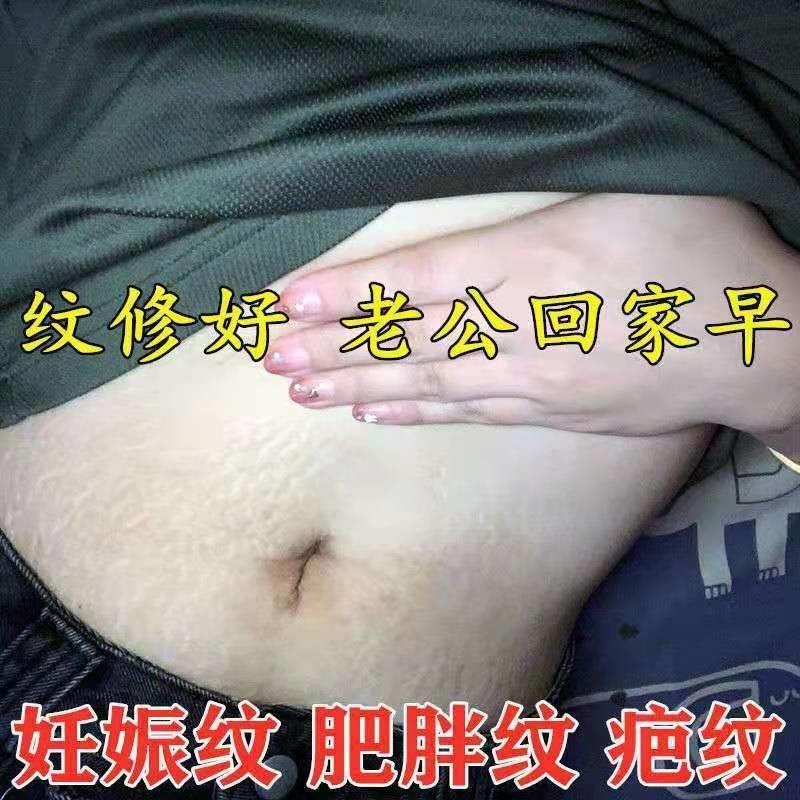 速发去妊娠纹肚子妊辰纹产後消除大腿肥胖纹生长纹预防紧致产後修