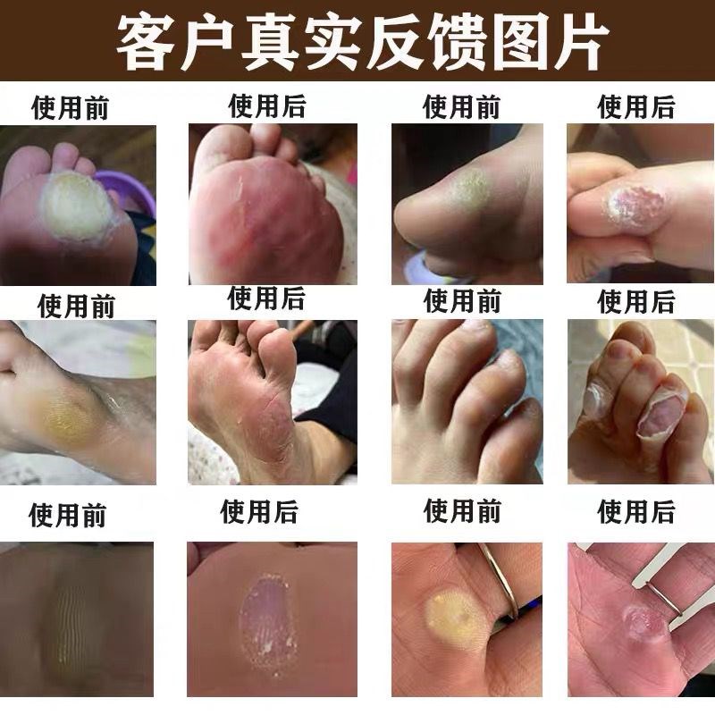 老茧软化剂祛脚茧脚底小脚趾厚茧老茧硬死皮去脚垫脚硬皮专用神器