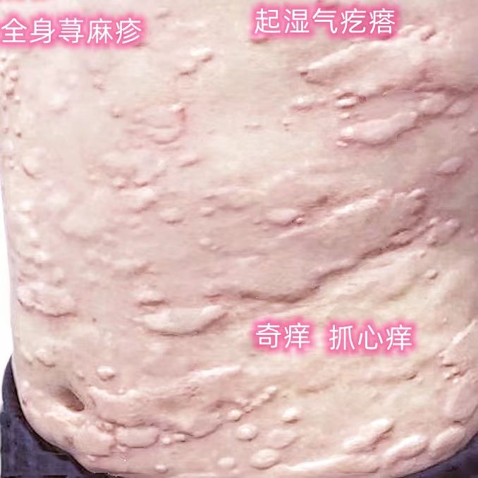 厂家荨麻疹过敏性风团全身皮肤瘙痒红疹疙瘩湿疹皮炎划痕老偏方止