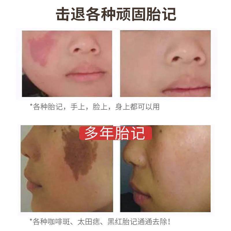 胎记去除神器脸部遮祛专用淡化咖啡斑遗传斑太田痣婴儿黑色素褐色