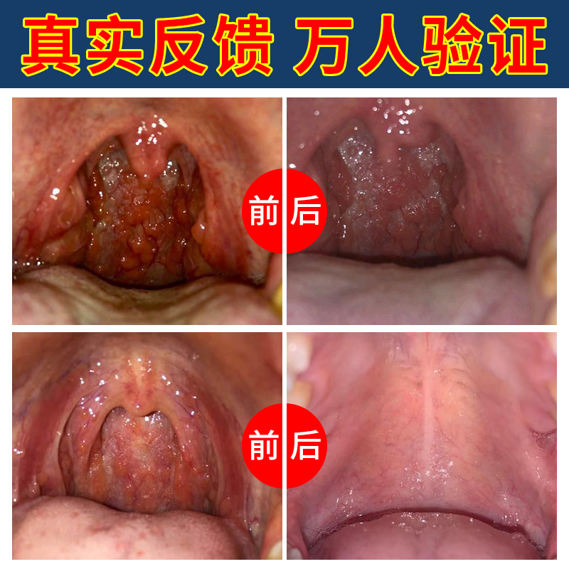 速发裉治咽炎慢性咽炎除根专用药喉咙有痰异物感痒干咳嗽咽喉炎喷