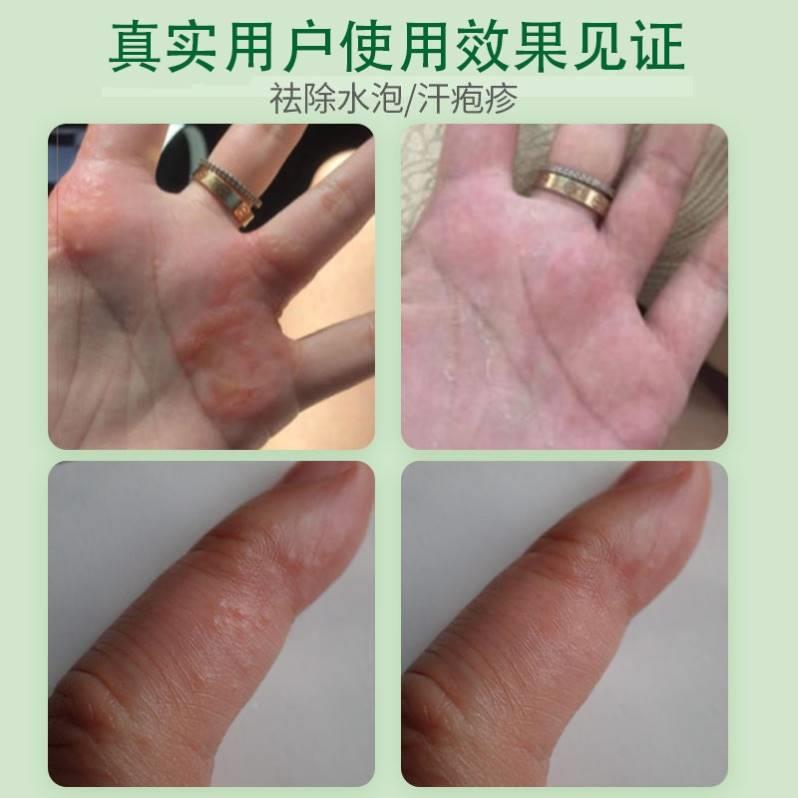 现货速发性护手霜角质季节性软膏儿童修复霜乾裂松懈剥脱症手脱皮